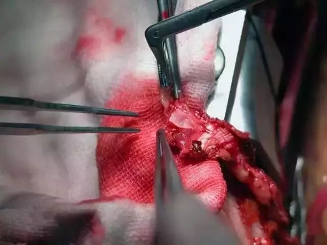 （高清手术图）静脉搭桥过程