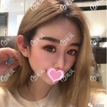 刘容嘉做双眼皮+仿生式隆鼻真人案例让我明白天津联合丽格是正规靠谱