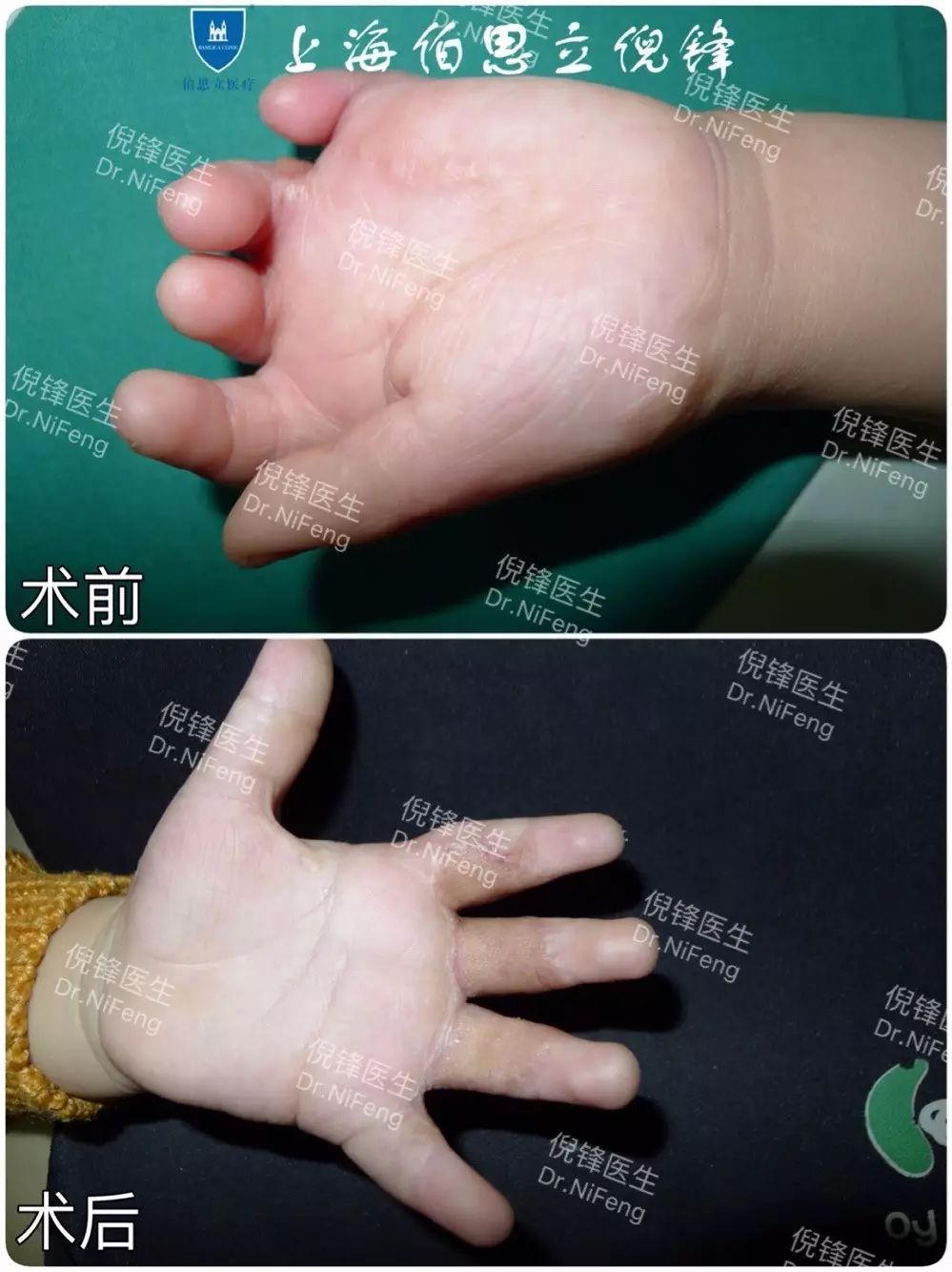 术后效果:手指植皮后不但功能完全恢复,而且植的皮色泽质地也令人