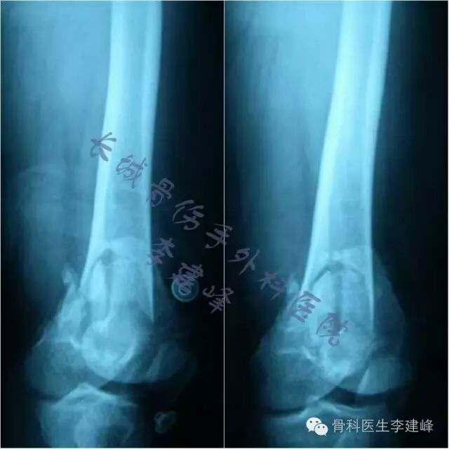 股骨远端骨折---固定方式决定手术成败!