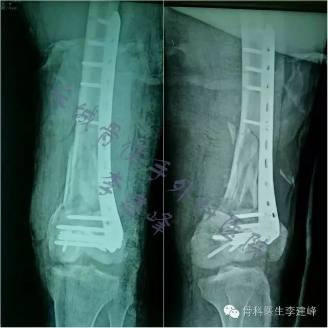 股骨远端骨折---固定方式决定手术成败!