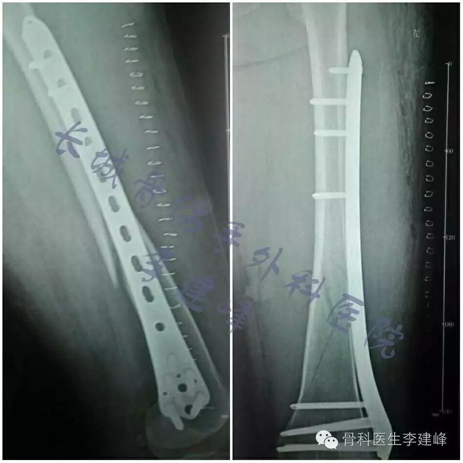 股骨远端骨折---固定方式决定手术成败!