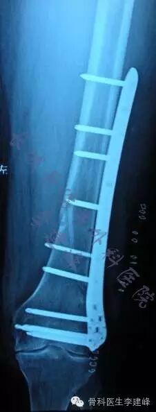 股骨远端骨折---固定方式决定手术成败!