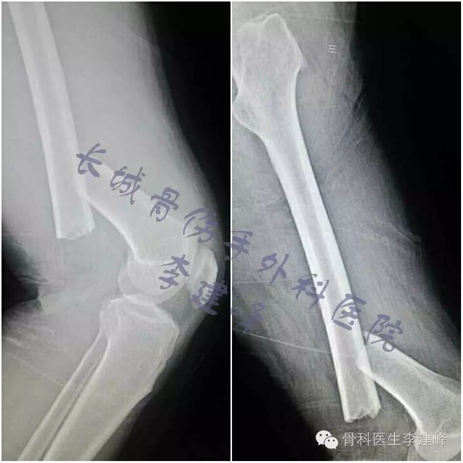 股骨远端骨折---固定方式决定手术成败!