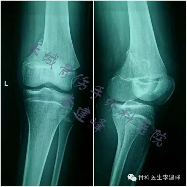 股骨远端骨折---固定方式决定手术成败!