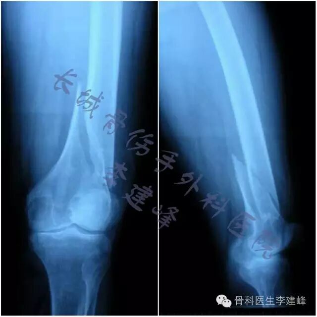 股骨远端骨折---固定方式决定手术成败!