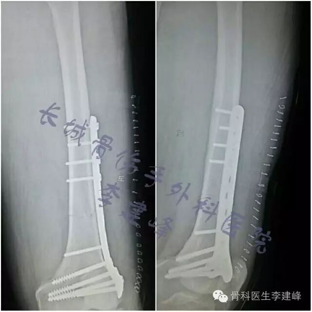 股骨远端骨折---固定方式决定手术成败!