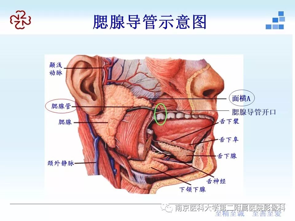 腮腺腺淋巴瘤的影像学表现