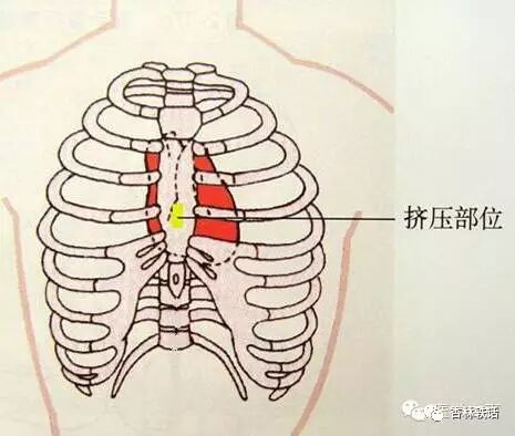cpr按压板怎么用心脏骤停时心肺复苏抢救（CPR）胸外心脏按压的10项细节要注意 ！_https://www.jmylbn.com_新闻资讯_第1张
