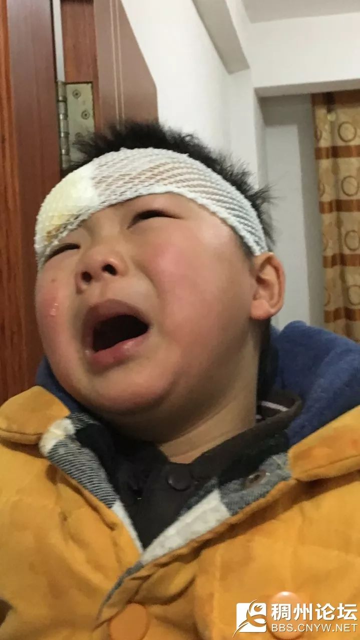 义乌一孩子在幼托班严重摔伤,眉毛缝了四针,园方强势回应.