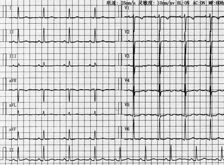 T波低平的诊断、病因、机制与意义……早看这篇早会了