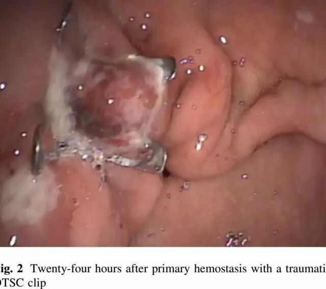 内镜夹怎么不掉CJP每周一帖--OTSC吻合夹系统在经内镜治疗消化道出血、穿孔及瘘中的应用_https://www.jmylbn.com_新闻资讯_第10张