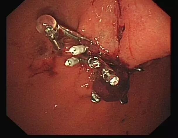 内镜夹怎么不掉CJP每周一帖--OTSC吻合夹系统在经内镜治疗消化道出血、穿孔及瘘中的应用_https://www.jmylbn.com_新闻资讯_第20张