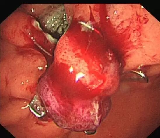 内镜夹怎么不掉CJP每周一帖--OTSC吻合夹系统在经内镜治疗消化道出血、穿孔及瘘中的应用_https://www.jmylbn.com_新闻资讯_第19张
