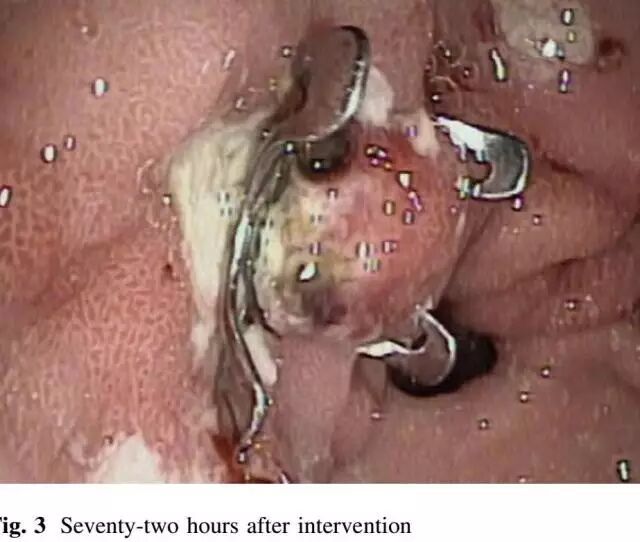 内镜夹怎么不掉CJP每周一帖--OTSC吻合夹系统在经内镜治疗消化道出血、穿孔及瘘中的应用_https://www.jmylbn.com_新闻资讯_第11张