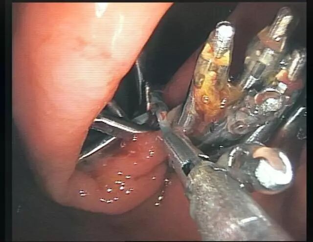 内镜夹怎么不掉CJP每周一帖--OTSC吻合夹系统在经内镜治疗消化道出血、穿孔及瘘中的应用_https://www.jmylbn.com_新闻资讯_第14张