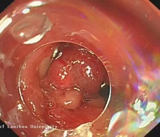 内镜夹怎么不掉CJP每周一帖--OTSC吻合夹系统在经内镜治疗消化道出血、穿孔及瘘中的应用_https://www.jmylbn.com_新闻资讯_第25张