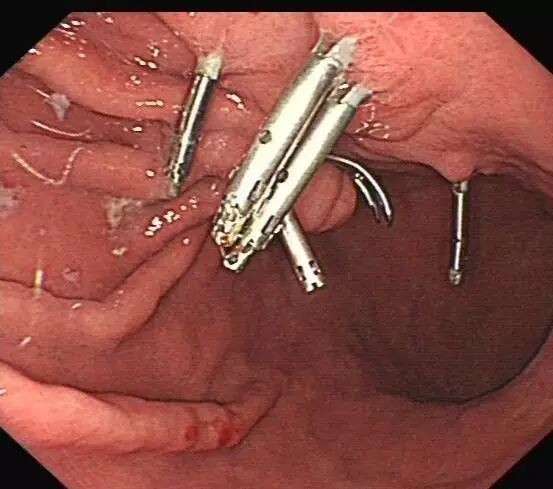 内镜夹怎么不掉CJP每周一帖--OTSC吻合夹系统在经内镜治疗消化道出血、穿孔及瘘中的应用_https://www.jmylbn.com_新闻资讯_第21张