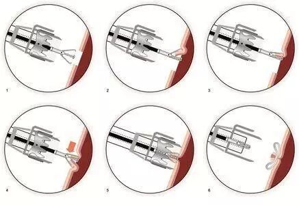 内镜夹怎么不掉CJP每周一帖--OTSC吻合夹系统在经内镜治疗消化道出血、穿孔及瘘中的应用_https://www.jmylbn.com_新闻资讯_第7张