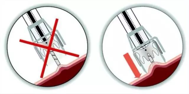 内镜夹怎么不掉CJP每周一帖--OTSC吻合夹系统在经内镜治疗消化道出血、穿孔及瘘中的应用_https://www.jmylbn.com_新闻资讯_第29张