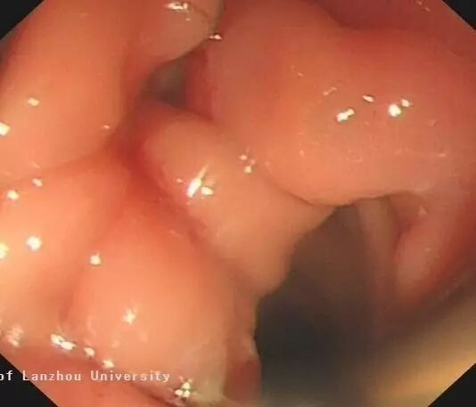 内镜夹怎么不掉CJP每周一帖--OTSC吻合夹系统在经内镜治疗消化道出血、穿孔及瘘中的应用_https://www.jmylbn.com_新闻资讯_第22张
