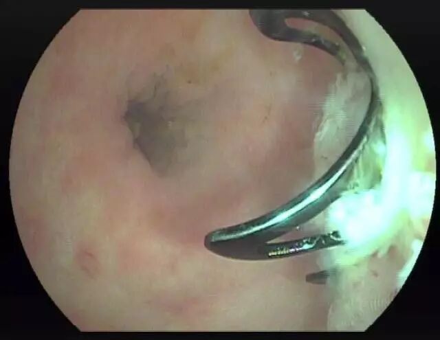 内镜夹怎么不掉CJP每周一帖--OTSC吻合夹系统在经内镜治疗消化道出血、穿孔及瘘中的应用_https://www.jmylbn.com_新闻资讯_第13张