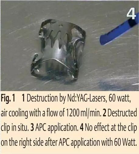 内镜夹怎么不掉CJP每周一帖--OTSC吻合夹系统在经内镜治疗消化道出血、穿孔及瘘中的应用_https://www.jmylbn.com_新闻资讯_第31张