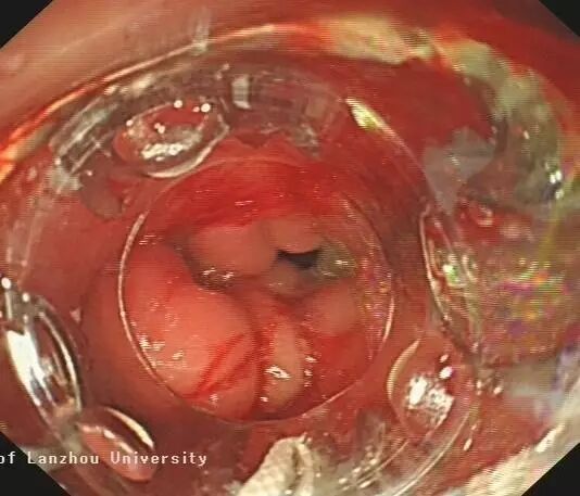 内镜夹怎么不掉CJP每周一帖--OTSC吻合夹系统在经内镜治疗消化道出血、穿孔及瘘中的应用_https://www.jmylbn.com_新闻资讯_第23张