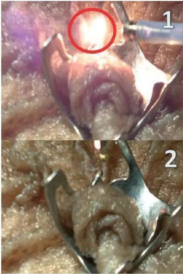 内镜夹怎么不掉CJP每周一帖--OTSC吻合夹系统在经内镜治疗消化道出血、穿孔及瘘中的应用_https://www.jmylbn.com_新闻资讯_第30张