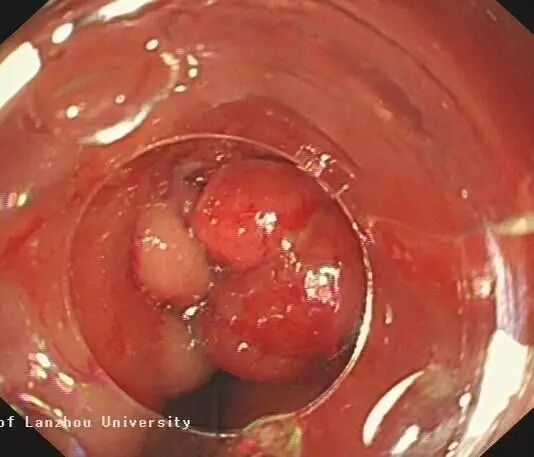 内镜夹怎么不掉CJP每周一帖--OTSC吻合夹系统在经内镜治疗消化道出血、穿孔及瘘中的应用_https://www.jmylbn.com_新闻资讯_第26张