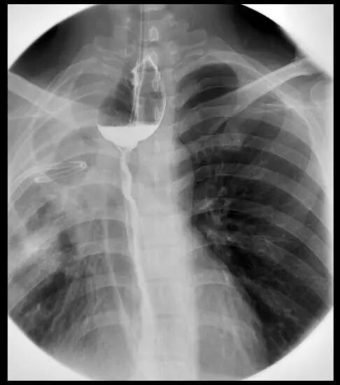 内镜夹怎么不掉CJP每周一帖--OTSC吻合夹系统在经内镜治疗消化道出血、穿孔及瘘中的应用_https://www.jmylbn.com_新闻资讯_第28张