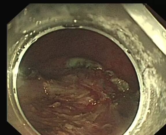 内镜夹怎么不掉CJP每周一帖--OTSC吻合夹系统在经内镜治疗消化道出血、穿孔及瘘中的应用_https://www.jmylbn.com_新闻资讯_第17张