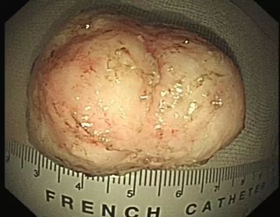 内镜夹怎么不掉CJP每周一帖--OTSC吻合夹系统在经内镜治疗消化道出血、穿孔及瘘中的应用_https://www.jmylbn.com_新闻资讯_第18张