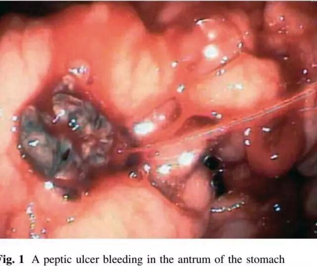 内镜夹怎么不掉CJP每周一帖--OTSC吻合夹系统在经内镜治疗消化道出血、穿孔及瘘中的应用_https://www.jmylbn.com_新闻资讯_第9张