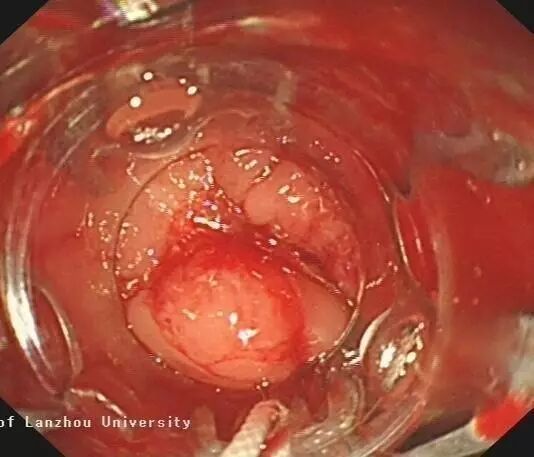 内镜夹怎么不掉CJP每周一帖--OTSC吻合夹系统在经内镜治疗消化道出血、穿孔及瘘中的应用_https://www.jmylbn.com_新闻资讯_第24张