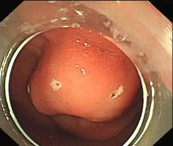 内镜夹怎么不掉CJP每周一帖--OTSC吻合夹系统在经内镜治疗消化道出血、穿孔及瘘中的应用_https://www.jmylbn.com_新闻资讯_第16张