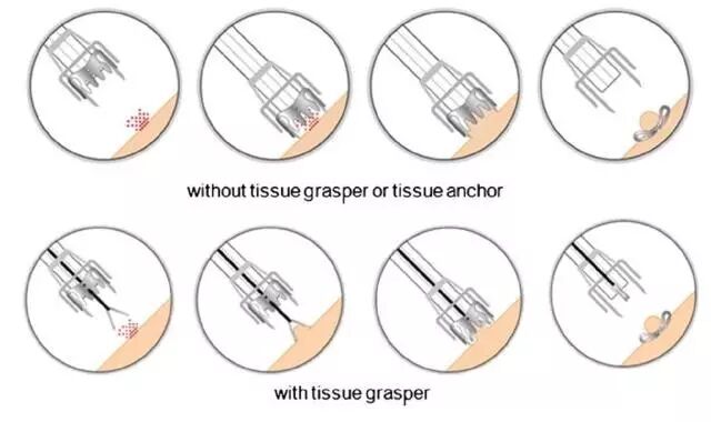 内镜夹怎么不掉CJP每周一帖--OTSC吻合夹系统在经内镜治疗消化道出血、穿孔及瘘中的应用_https://www.jmylbn.com_新闻资讯_第6张