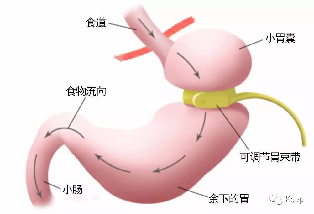 手术减肥_减肥手术有哪些方法_减肥手术哪种效果好