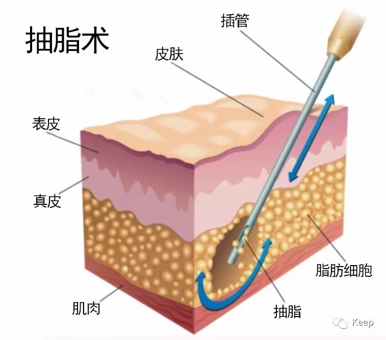 手术减肥_减肥手术哪种效果好_减肥手术有哪些方法