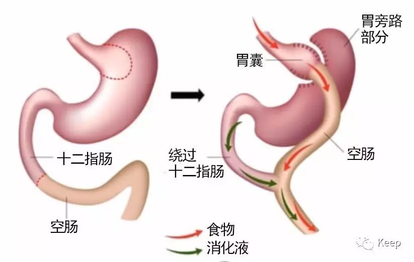 手术减肥_减肥手术哪种效果好_减肥手术有哪些方法