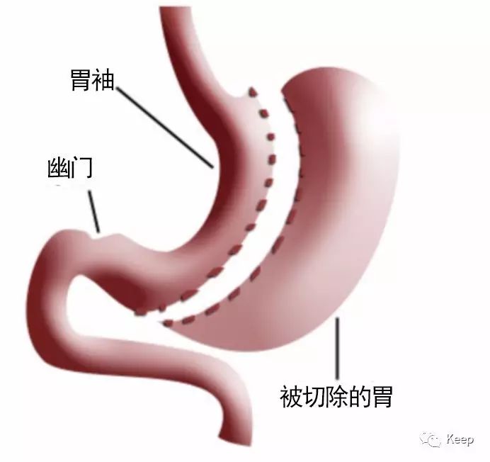 减肥手术有哪些方法_减肥手术哪种效果好_手术减肥