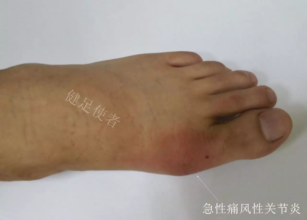 一位痛风病友,突然出现大脚趾头的红肿热痛,赶紧去医院,医生诊断为