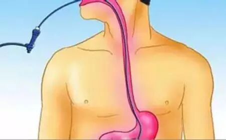 怎么拔鼻腔引流管胃管术（二）_https://www.jmylbn.com_新闻资讯_第58张