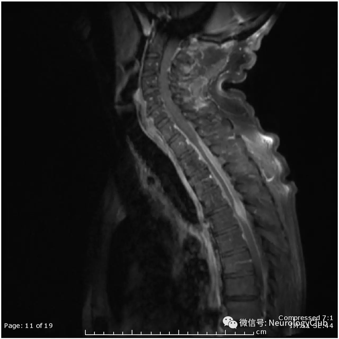 肥厚性硬膜炎hypertrophicpachymeningitis