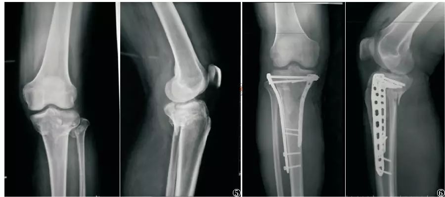图5为患者术前x线片,示胫骨平台粉碎性骨折,左图为x线正位片,右图为