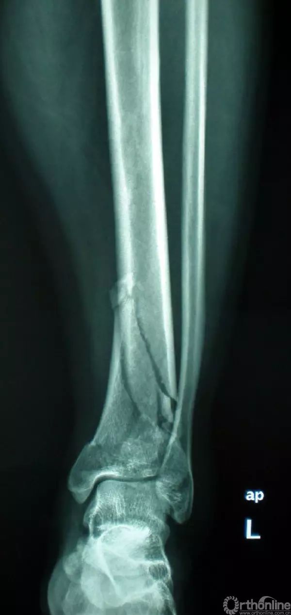 pilon骨折的ct分型及其临床指导意义