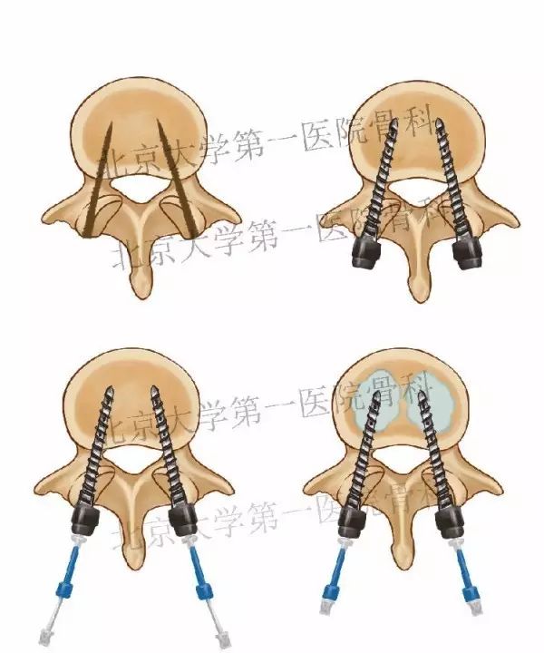 椎弓根螺钉骨水泥钉道强化材料的应用进展