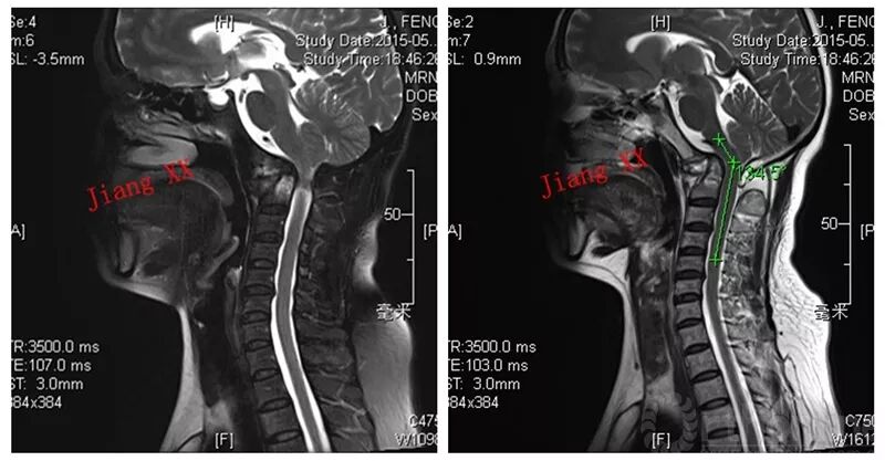 病例一:患者女性,49岁,因颈部活动受限4月入院,诊断为寰枢椎脱位,颅底