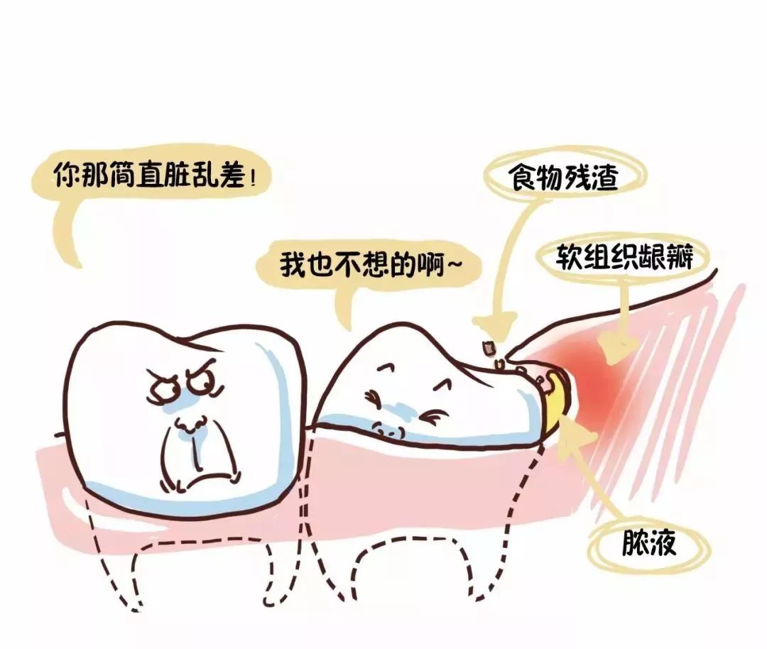 【知识】智齿长成这样一定要拔除!80%的. - ss的