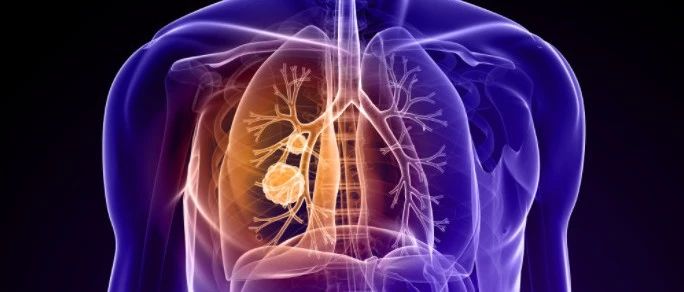 2018盘点|肺癌最新研究进展